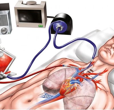 Extracorporeal membrane oxygenation (ECMO)